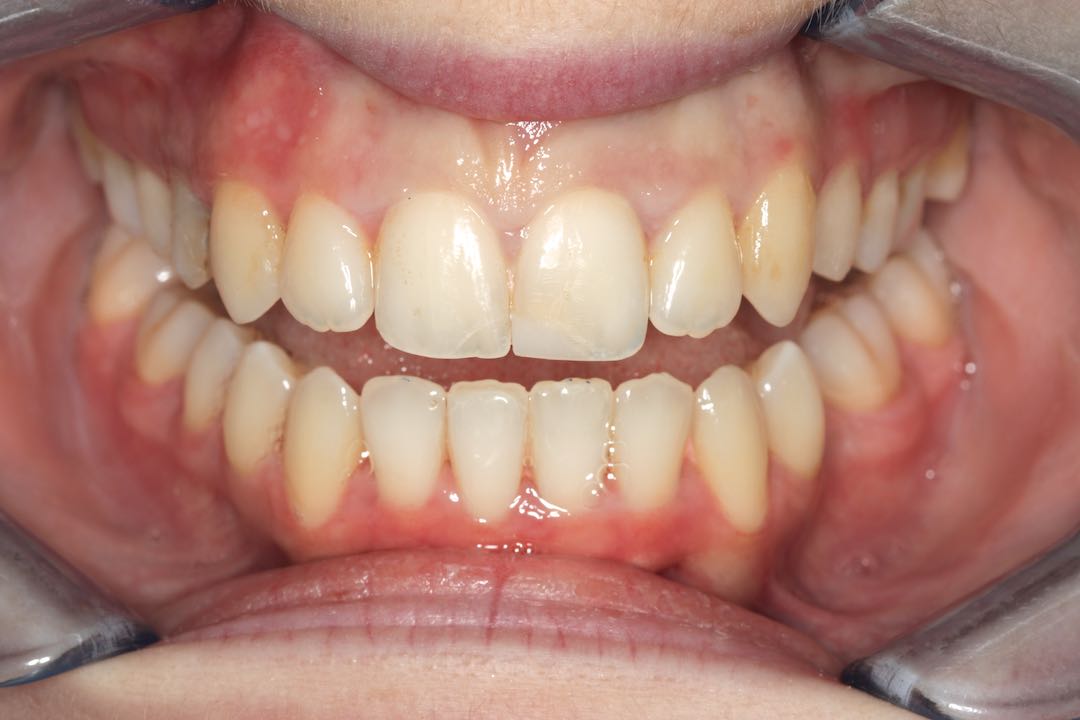 Invisalign i7 Lite West Malling Dental, Kent