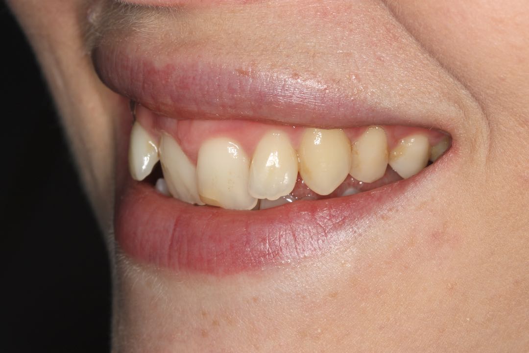 Invisalign i7 Lite West Malling Dental, Kent