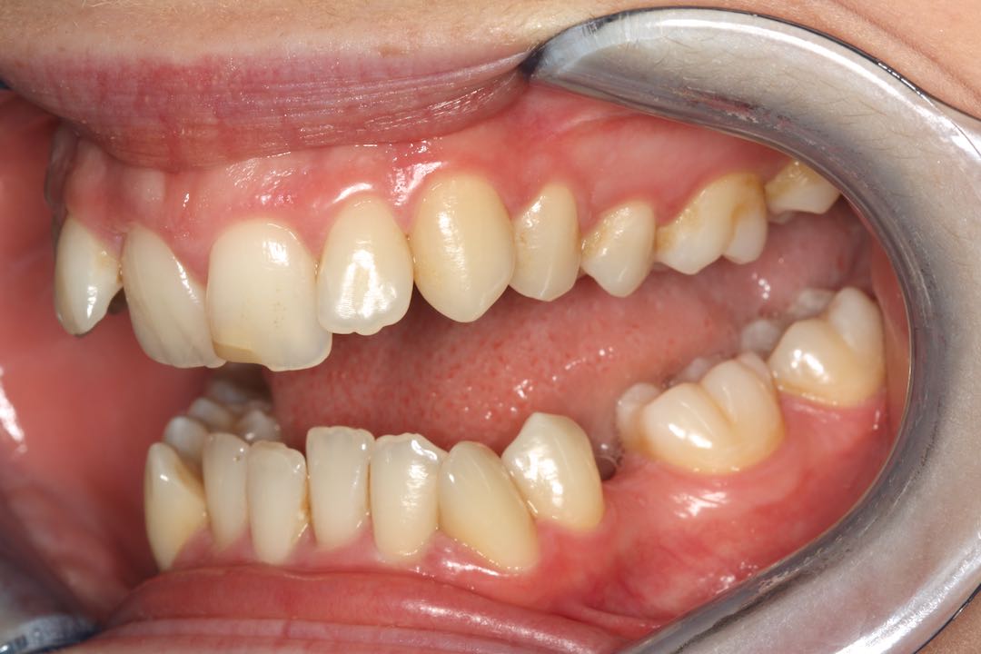 Invisalign i7 Lite West Malling Dental, Kent