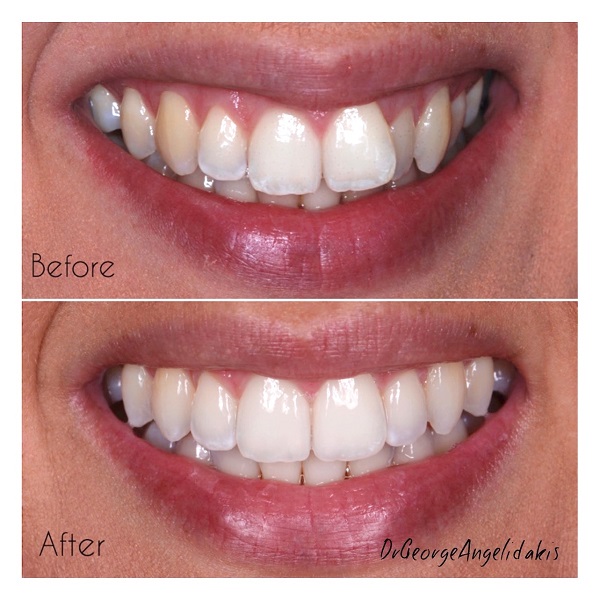 Invisalign i7 Lite West Malling Dental, Kent