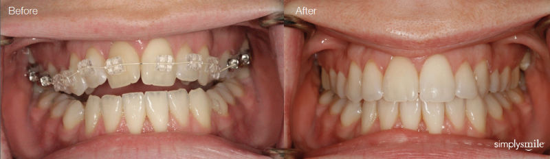 Simply Smile Orthodontics, before and after photos.