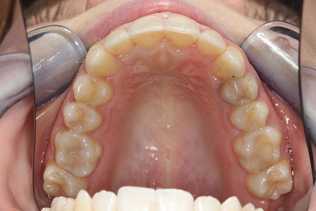 after invisalign upper arch