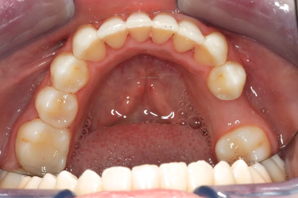after invisalign lower arch