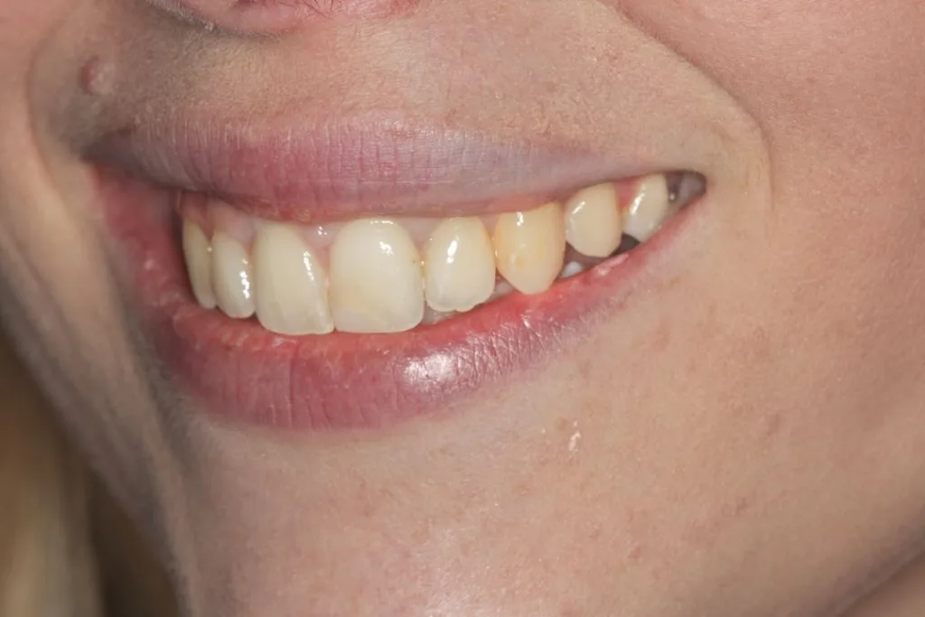 after invisalign