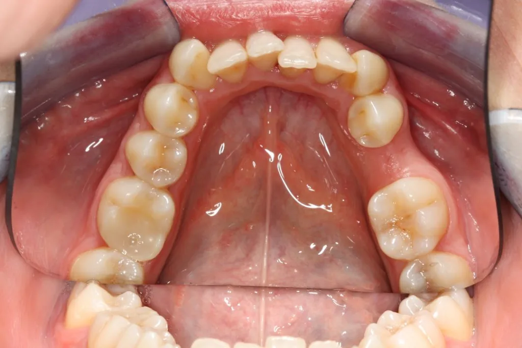 before invisalign lower arch