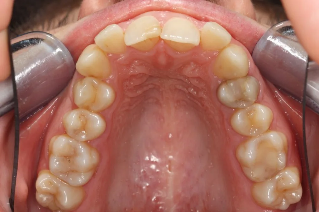 before invisalign upper arch