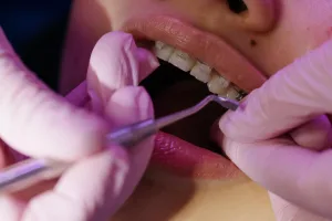 retainers