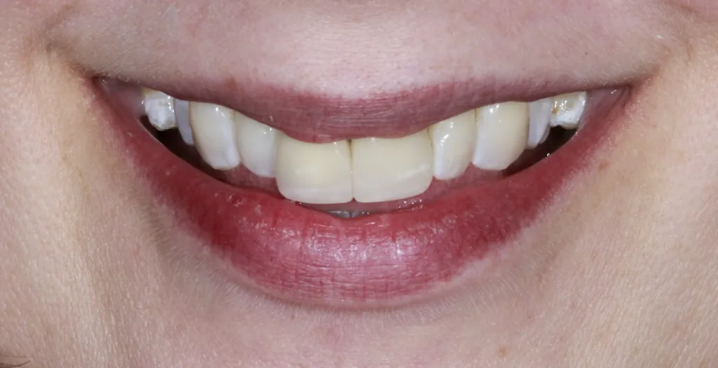 Before teeth whitening