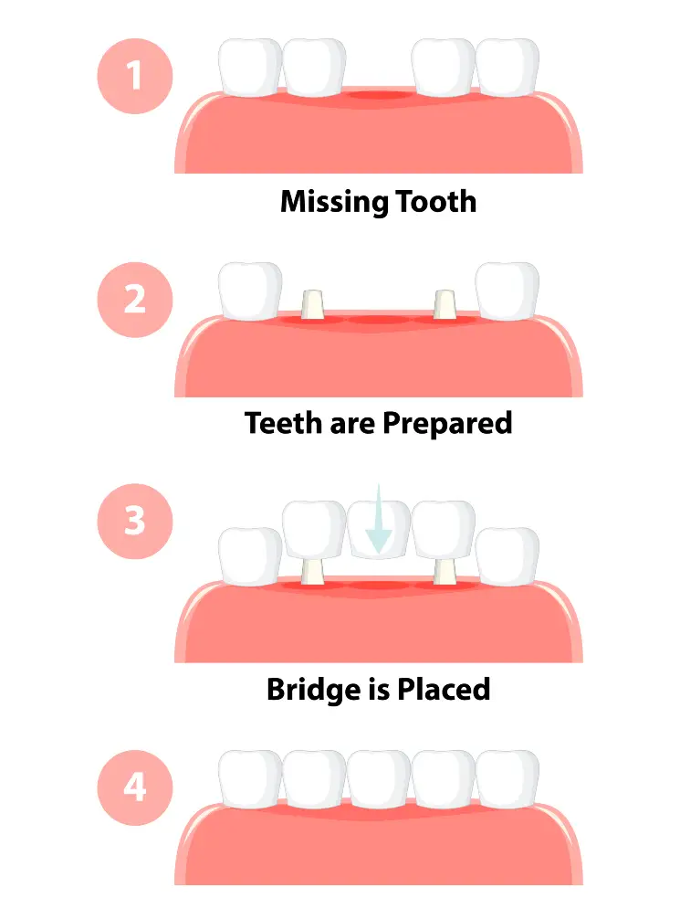 dental bridge