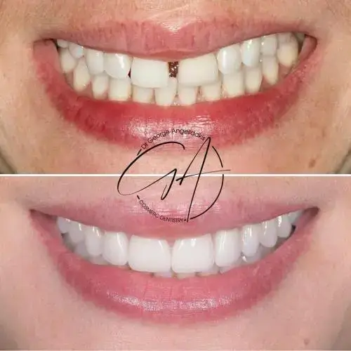 Composite bonding gap