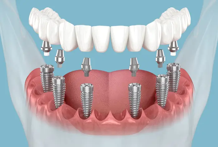 all on 6 dental implants 