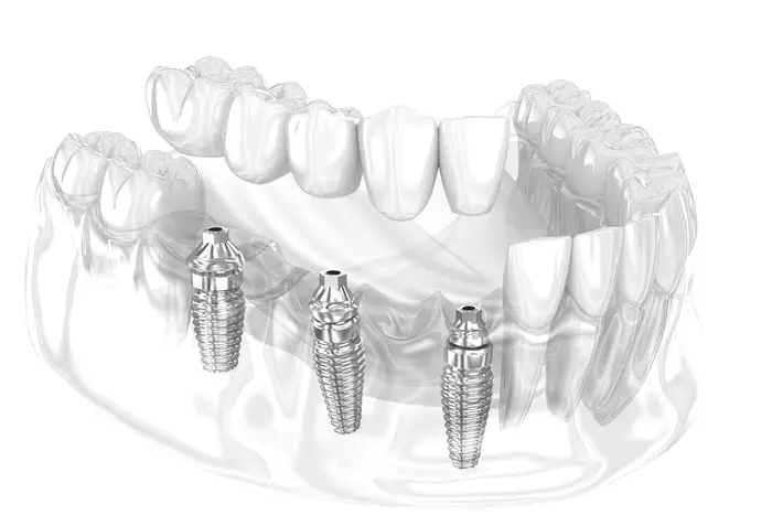 Multiple implant surgery illustration