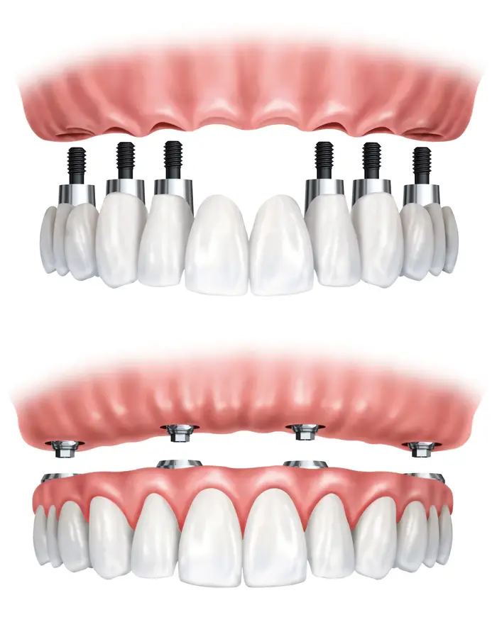 all on 4 and 6 dental implants - full arch