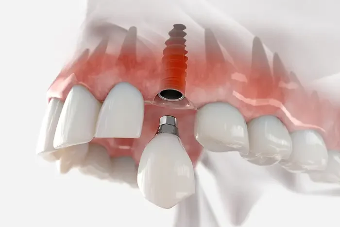 Single dental implant illustration