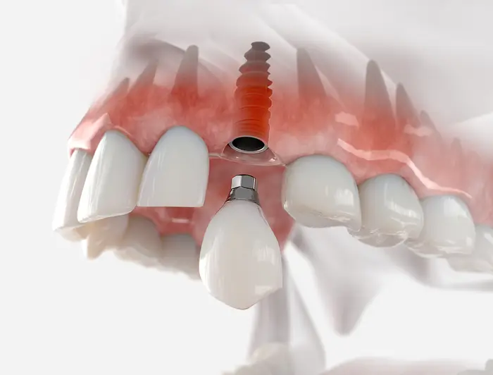 Single dental implant illustration