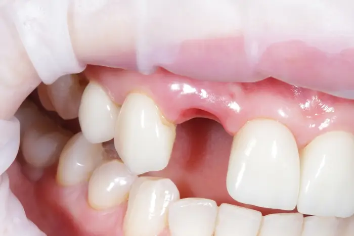 single dental implant surgery