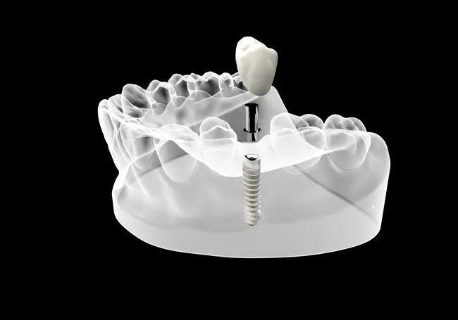 west malling dental implants are the best