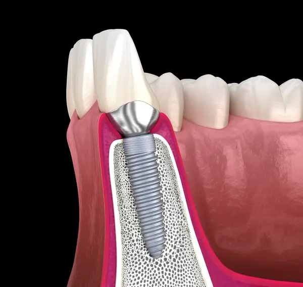 quality dental implants