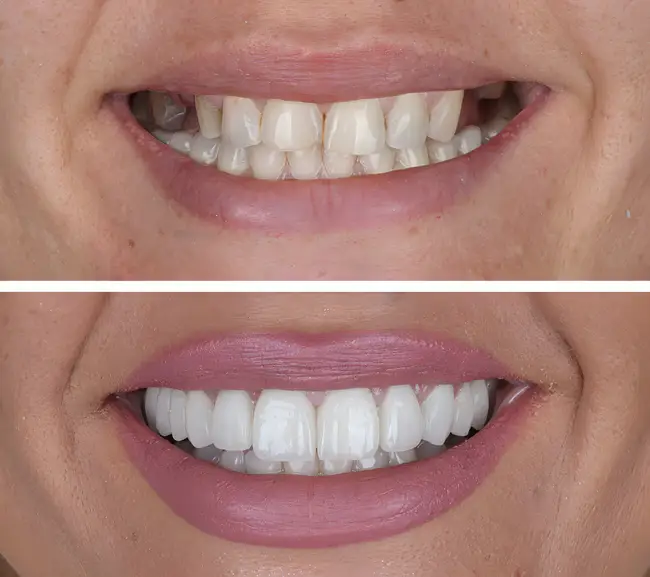 excellent before and after for dental implants