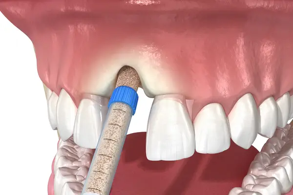 missing jaw bone for dental implants