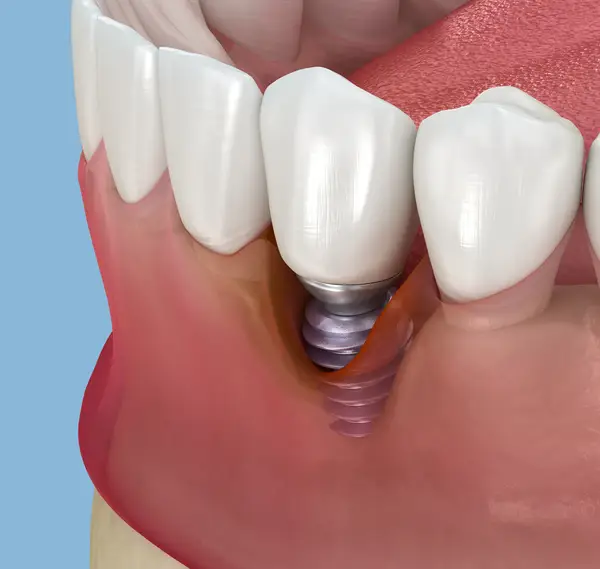 Gum diseasearound an implant is avoided by good oral hygiene and regular implant cleaning visits.