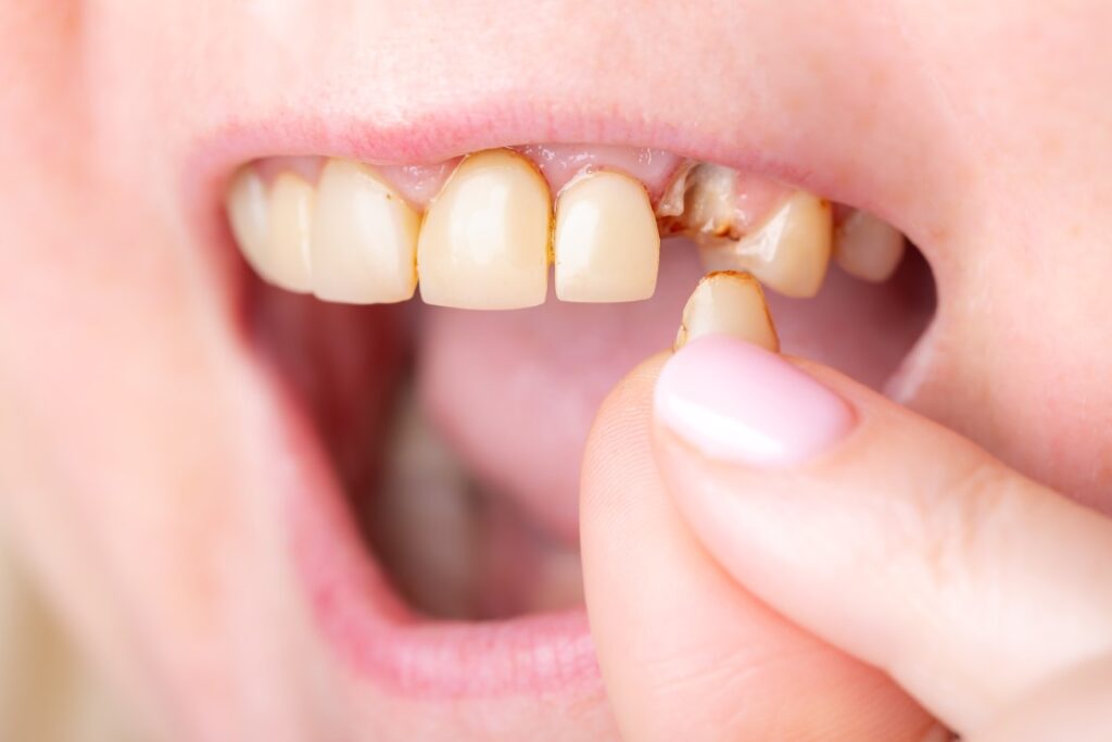 Damage caused by tooth decay