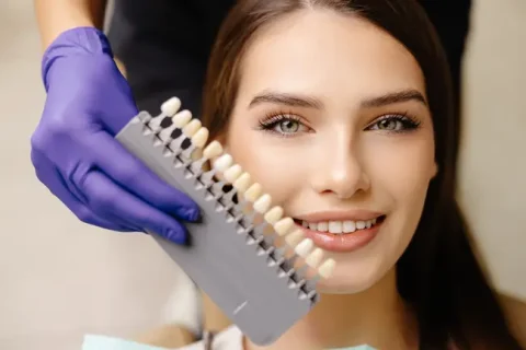 whtiening-shades whitening shades