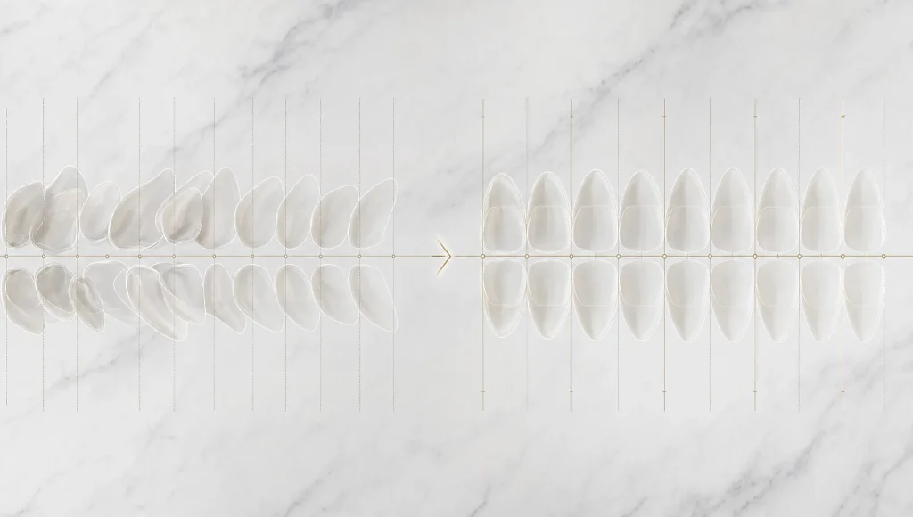 Overlapping tooth outlines and alignment marks show a smile gradually becoming more symmetrical.