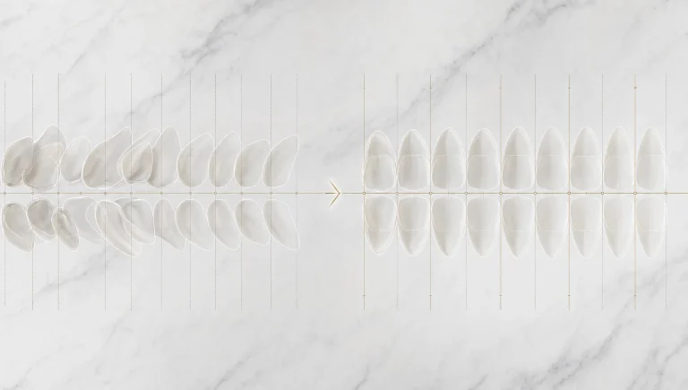Overlapping tooth outlines and alignment marks show a smile gradually becoming more symmetrical.