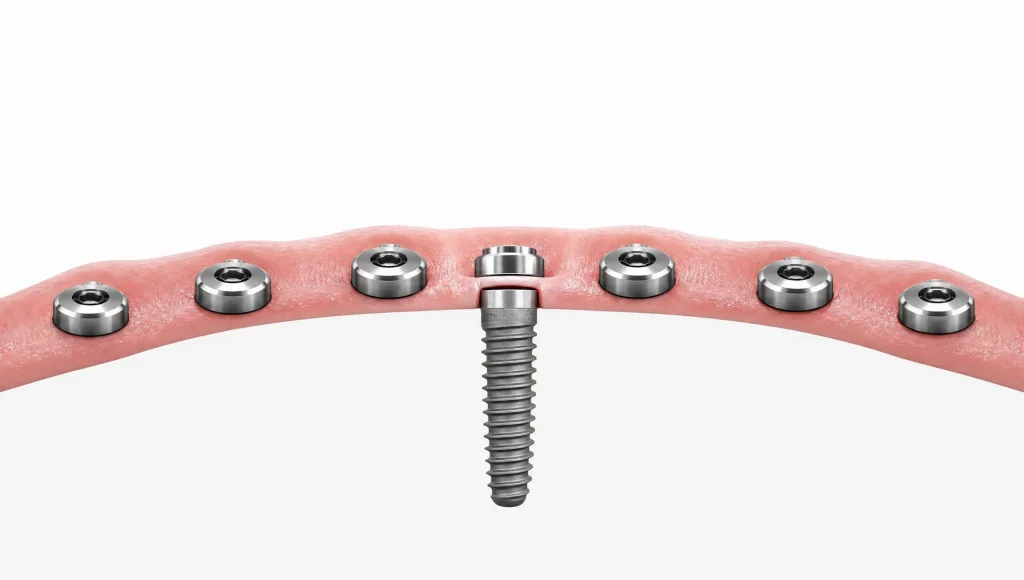 Simple implant shapes and a gum line arc suggest planning and stability for dental implants.
