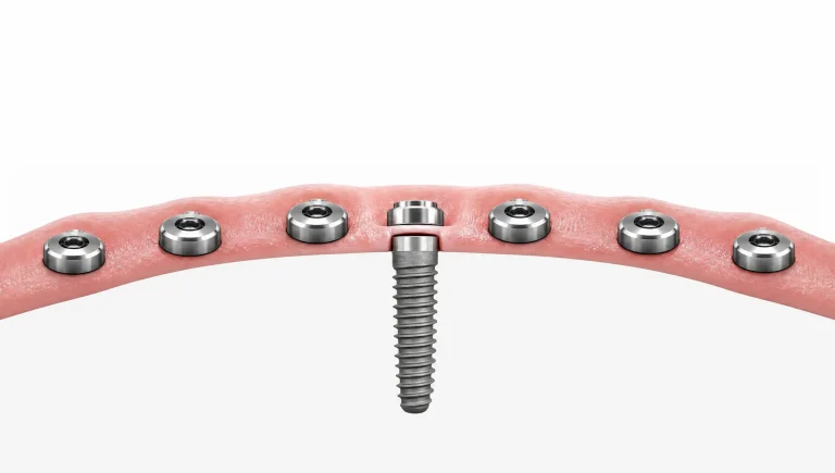 Simple implant shapes and a gum line arc suggest planning and stability for dental implants.