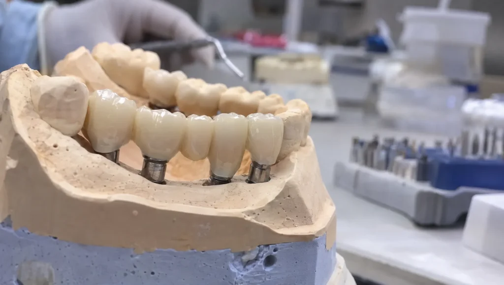 An implant-supported bridge fitted across several teeth on a jaw model, showing the connections planned to support replacement teeth.